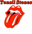 How to remove tonsil stones 3630.jpg